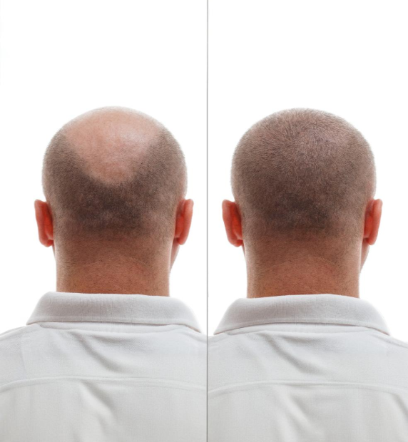 Before After 2 (2)