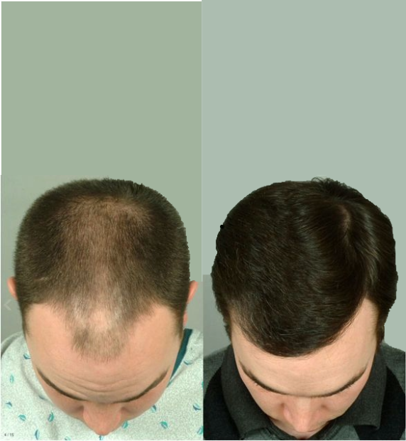 Before After 4 (2)